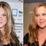 Amy Schumer's Plastic Surgery
