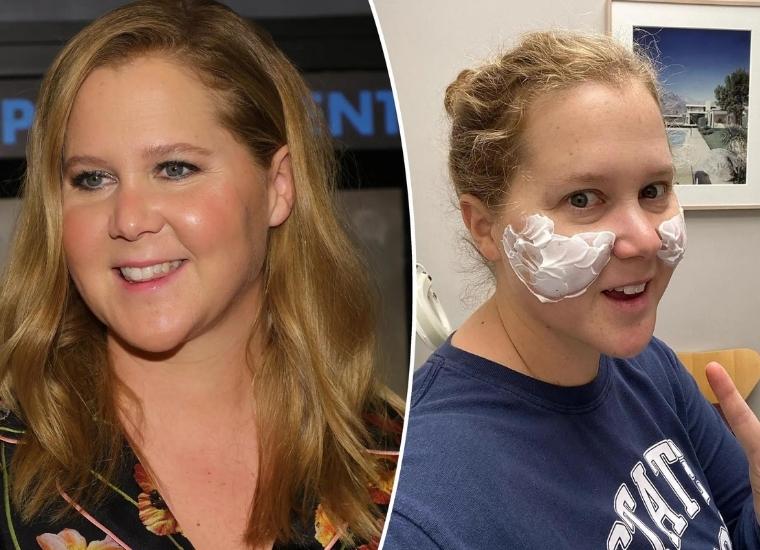 Amy Schumer's Plastic Surgery in 2024