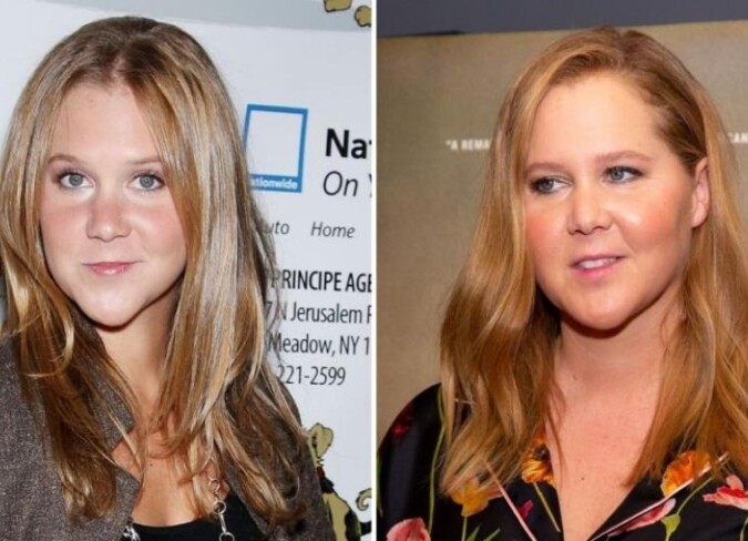 Amy Schumer's Plastic Surgery