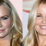 Jennifer Coolidge Plastic Surgery