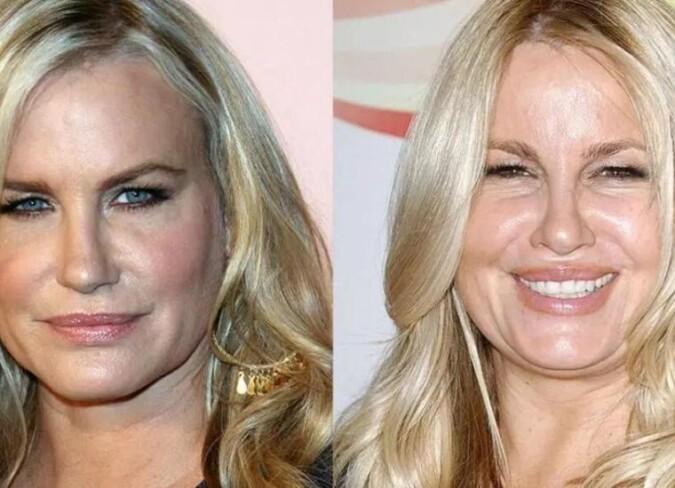 Jennifer Coolidge Plastic Surgery