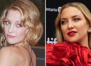 Kate Hudson's Plastic Surgery: Her Transformation in Comparison to