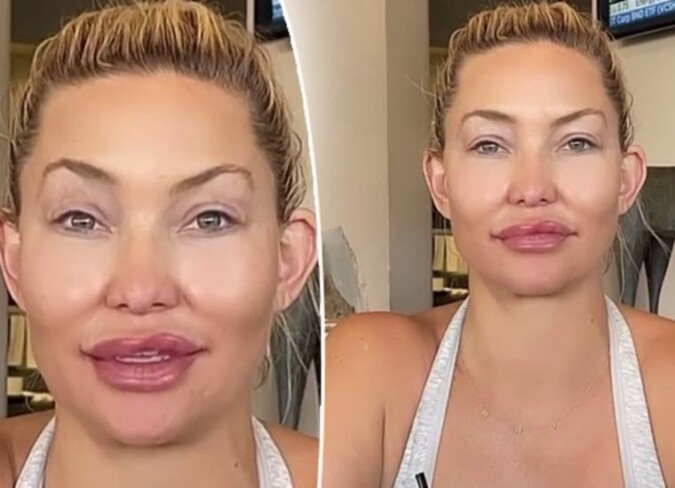 Kate Hudson&rsquo;s Plastic Surgery: Her Transformation in Comparison to