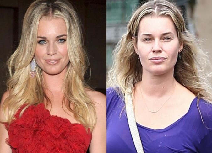 Rebecca Romijn Plastic Surgery