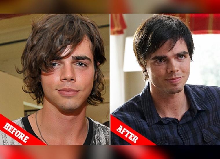 Reid Ewing's Plastic Surgery