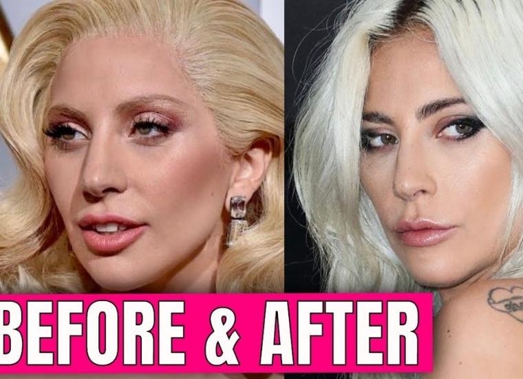 She Has Confessed To Being "Very Obsessed" With Fillers
