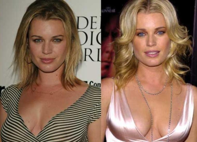 Surgery Statement From Rebecca Romijn