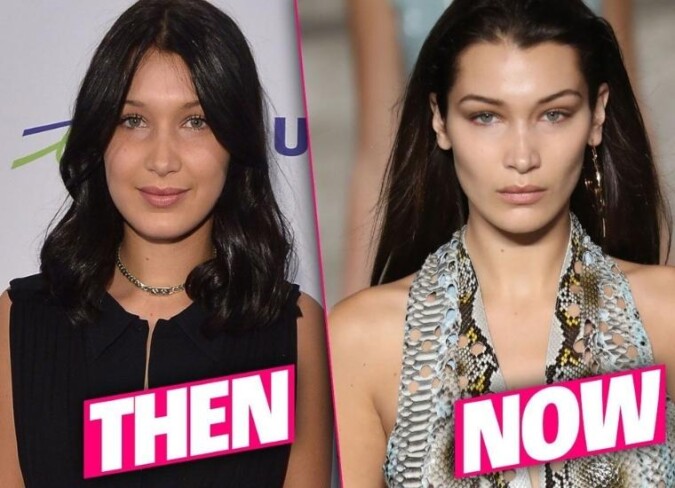 Bella Hadid's Plastic Surgery