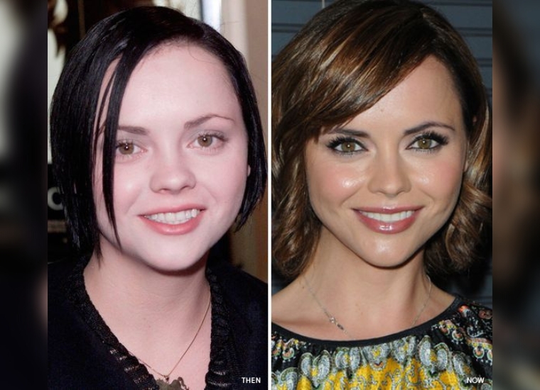 Christina Ricci's Botox Injections