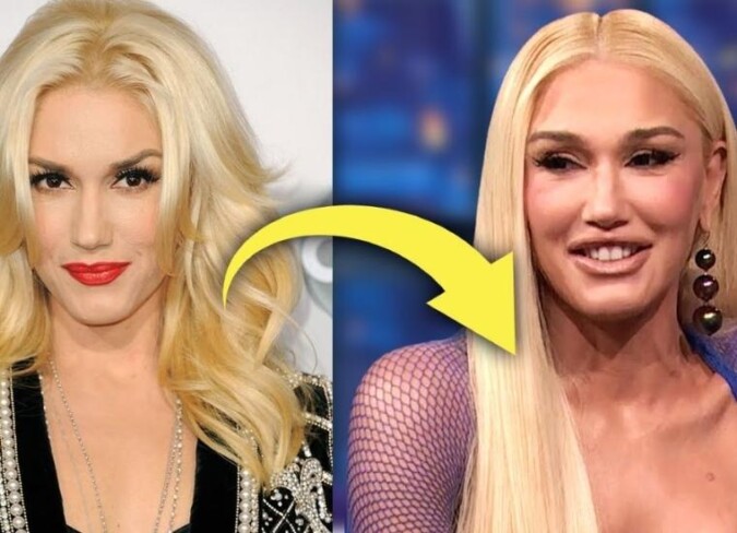 Gwen Stefani Plastic Surgery Interview