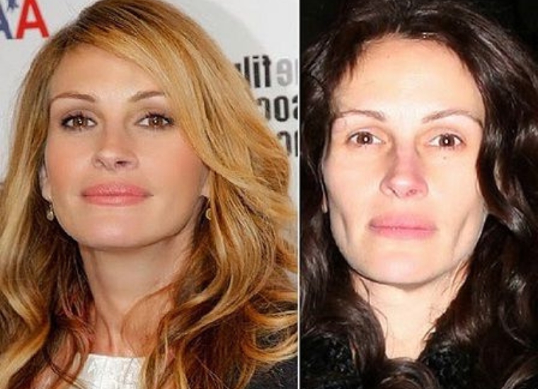 Julia Roberts Plastic Surgery