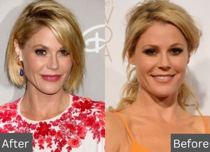 Julie Bowen's Plastic Surgery