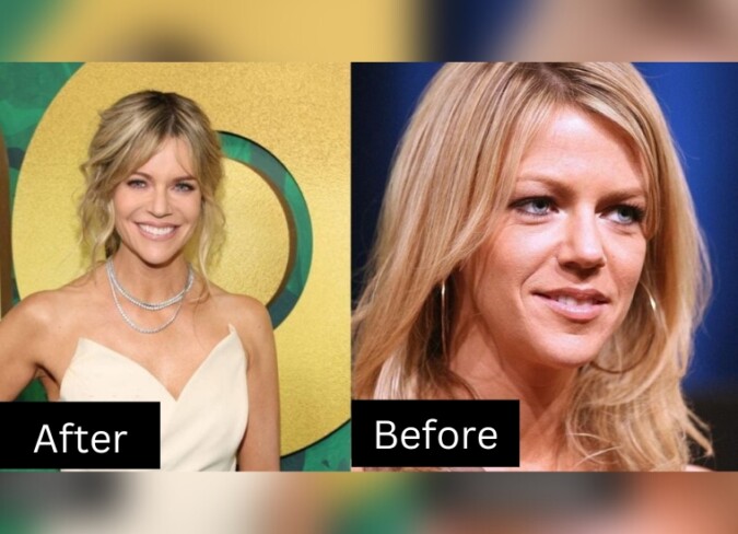 Kaitlin Olson's Plastic Surgery