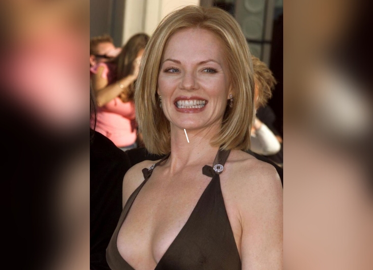 Marg Helgenberger Plastic Surgery