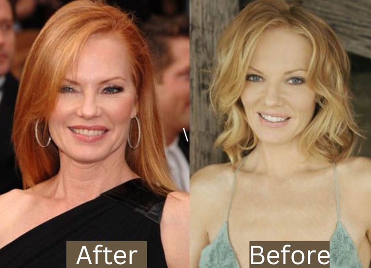 Marg Helgenberger's Plastic Surgery 2024