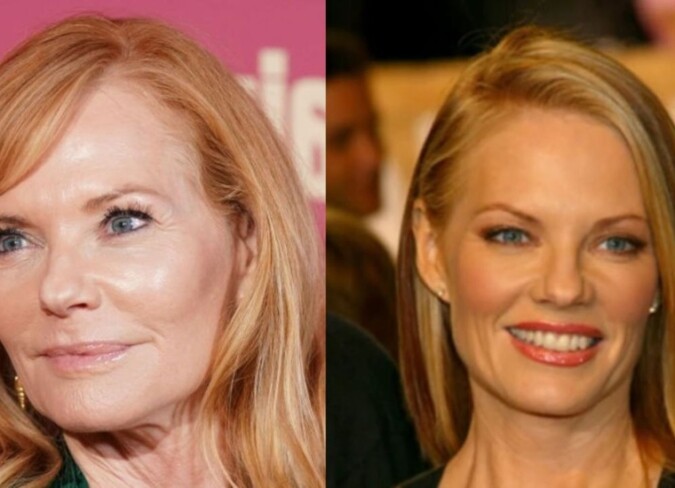 Marg Helgenberger's Plastic Surgery