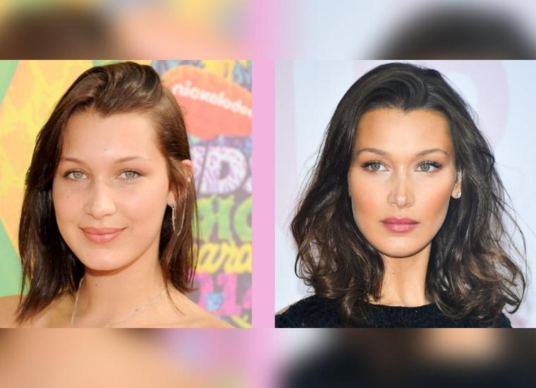 Fans Believe The Facelift And Eye Lift