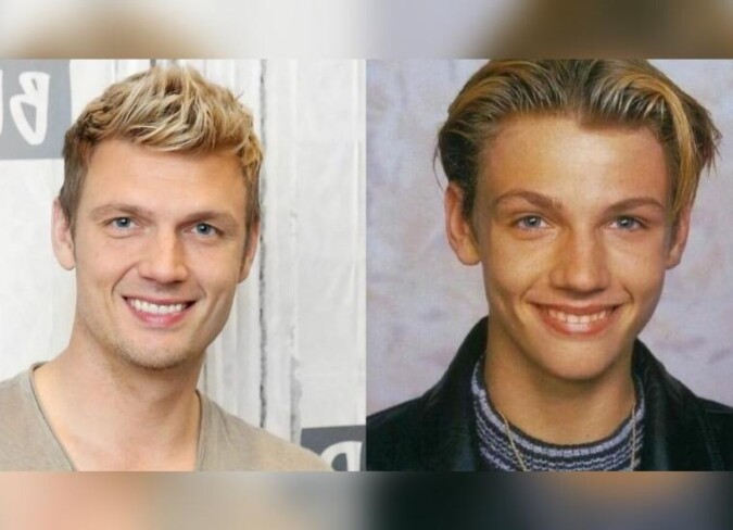 Nick Carter's Plastic Surgery