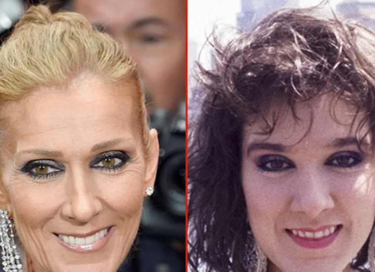 Celine Dion Plastic Surgery 2024