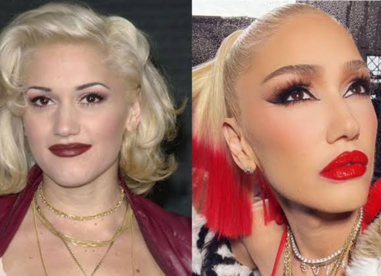 Fans Think Gwen Stefani Had A "Botox Lip Flip."