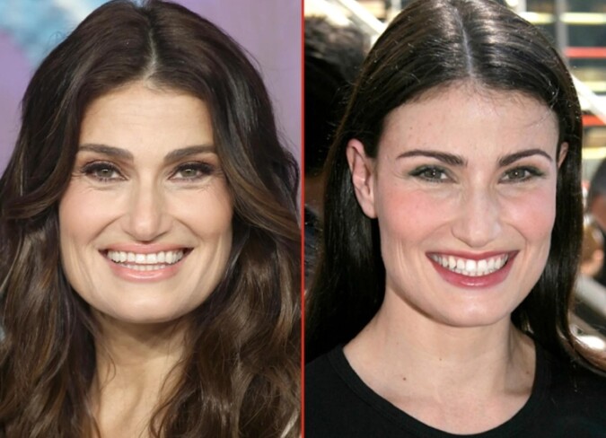 Idina Menzel Plastic Surgery