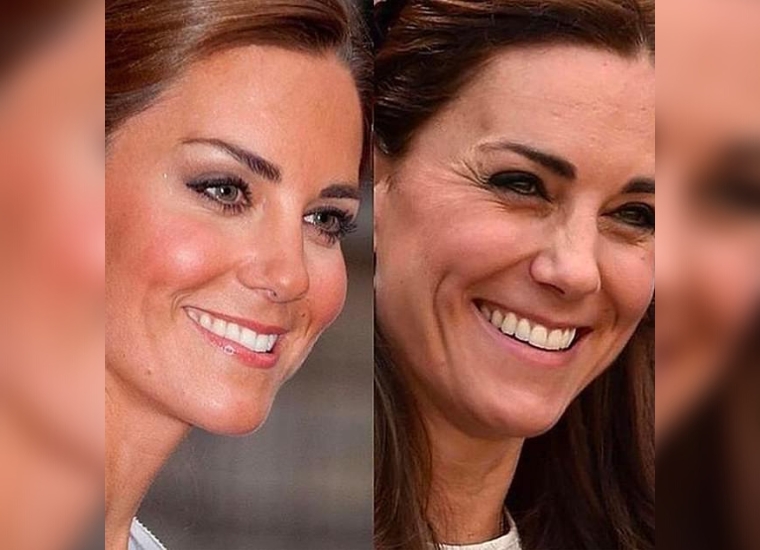 Kate Middleton Had Plastic Surgery?