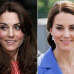 Kate Middleton Plastic Surgery