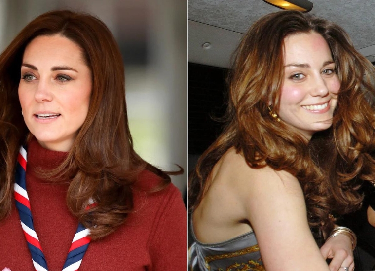 Kate Middleton Plastic Surgery 2024