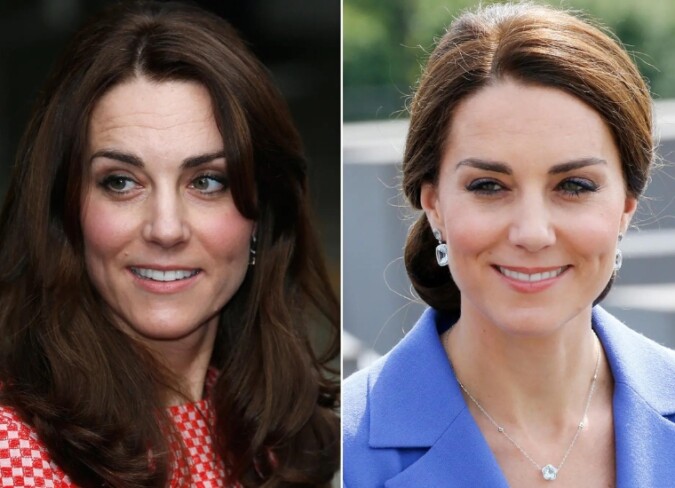 Kate Middleton Plastic Surgery