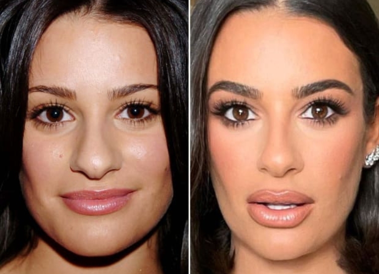 Lea Michele Plastic Surgery 2024