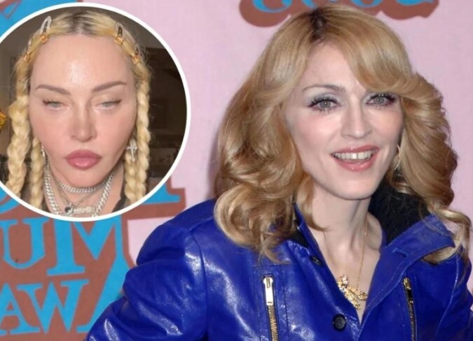 Madonna Plastic Surgery Daily Mail