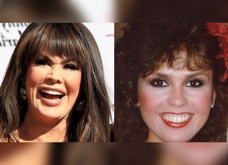 Marie Osmond Plastic Surgery 2024