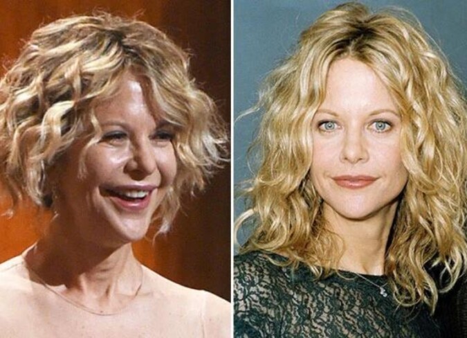 Meg Ryan Plastic Surgery