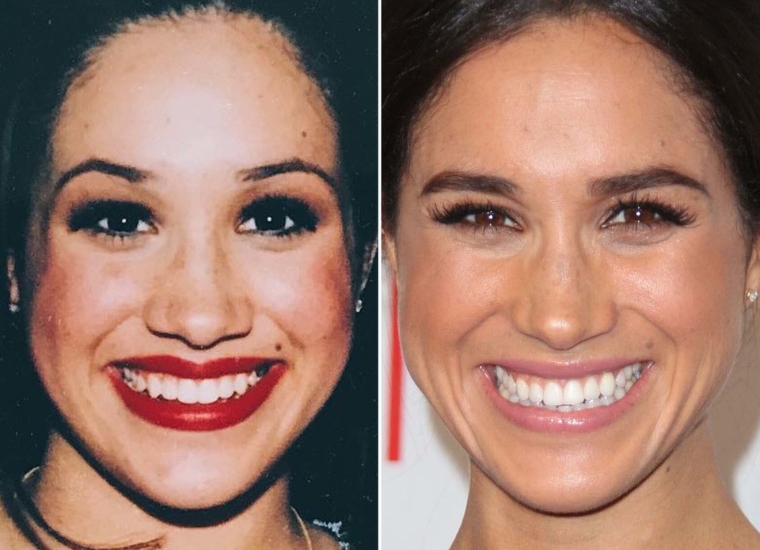 Meghan Markle Plastic Surgery 2024