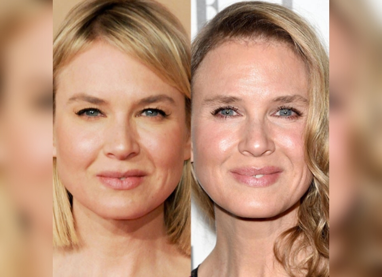 Renee Zellweger Plastic Surgery 2024