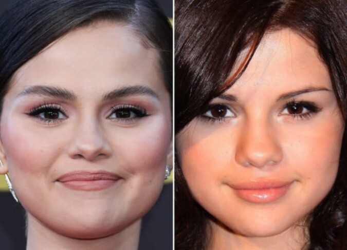 Selena Gomez Plastic Surgery