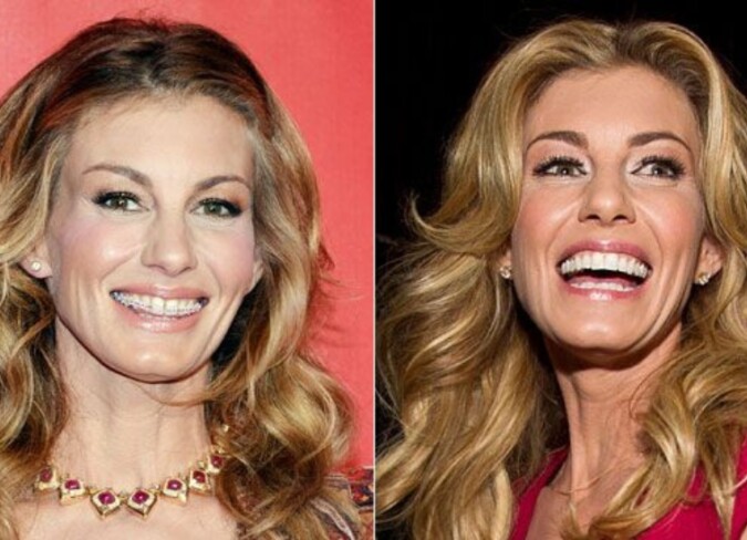 Faith Hill Plastic Surgery