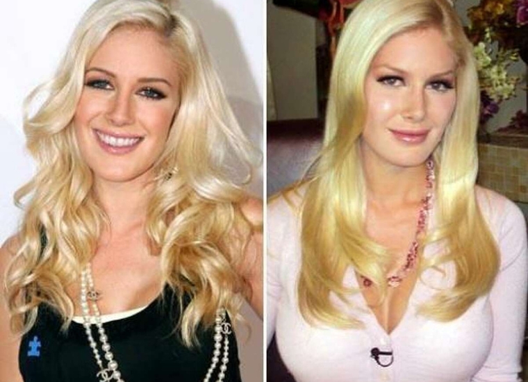 Heidi Pratt' Plastic Surgery 2024